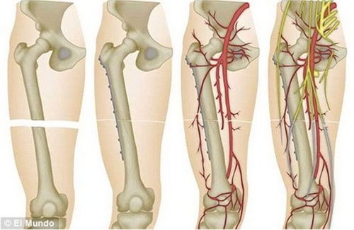 Sơ đồ thể hiện quá trình phẫu thuật ghép chân cho bệnh nhân - Ảnh: DM